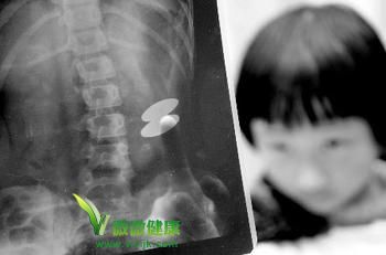 4岁女童误吞磁铁 36天未见排出将手术