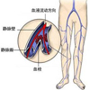 女性小腿静脉曲张最好生育后再做手术