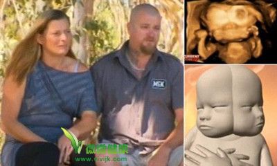 澳女子诞下“双脸婴” 全球第35例(图)