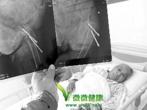 102岁老太动手术 从体内取出两颗螺丝