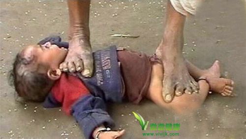 印度巫医踩踏小孩治喉痛咳嗽的方法,太恐怖了