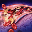 镰状细胞贫血需要多输血吗